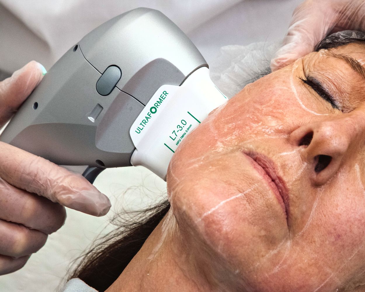 After laser hair removal results