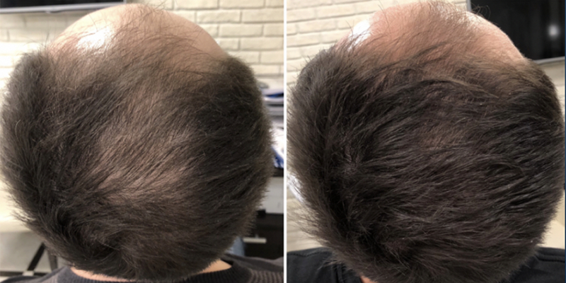 Before laser hair removal treatment