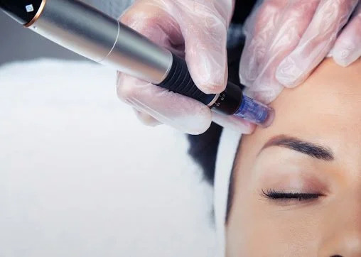 Laser hair removal in progress