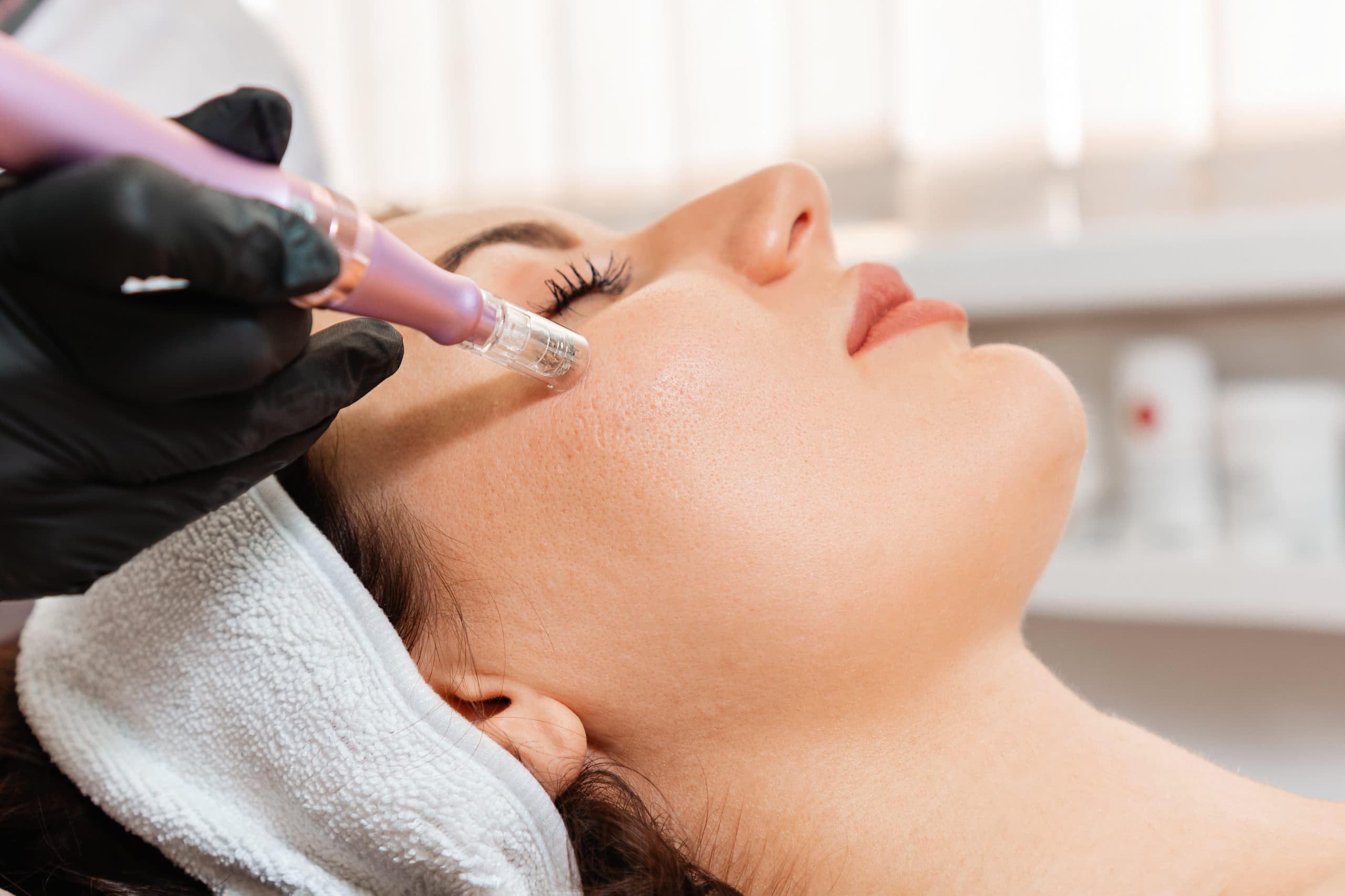 After laser hair removal results
